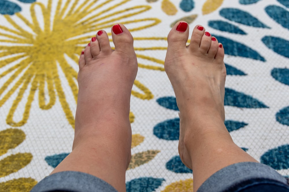 How to Reduce Swelling in Feet